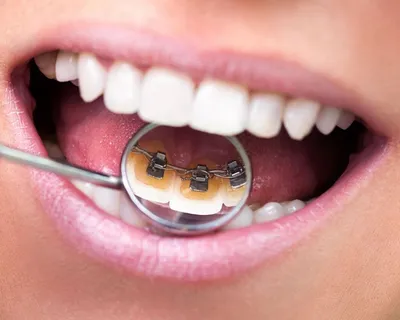 Лингвальные брекеты в стоматологии: цены, показания и рекомендации |  Стоматологические услуги в клинике Церекон в Москве