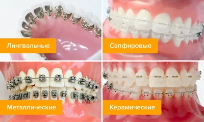 Установка брекетов на зубы — подготовка, этапы, уход на Startsmile.ru