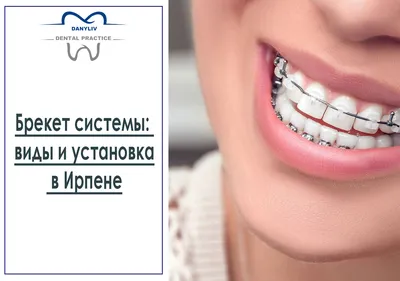 Брекет системы: виды и установка в Ирпене / Блог / Стоматология Danyliv  Dental Practice