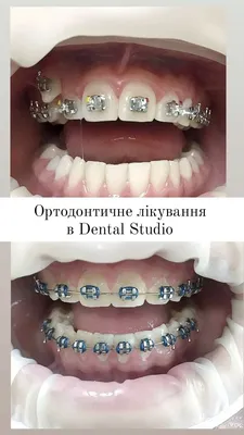 Брекет-системы | Стоматология в Запорожье Dental Studio