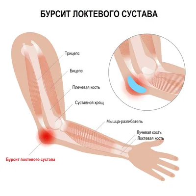 Бурсит коленного сустава - Первая Медицинская Клиника