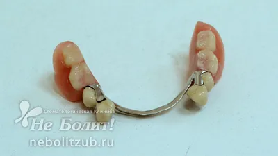 Бюгельные протезы с замками и на крючках-кламмерах, протезирование  жевательных зубов - Видео - Блог | Стоматологическая клиника Не Болит!