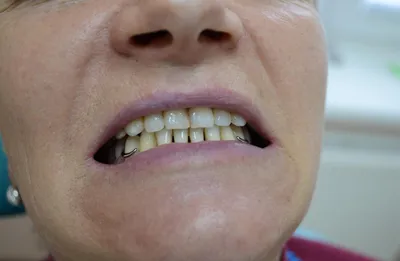 Бюгельное протезирование зубов в СПб - цена на бюгельный протез, отзывы о  процедуре