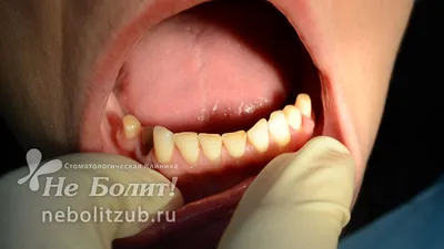 Бюгельные протезы с замками и на крючках-кламмерах, протезирование  жевательных зубов - Видео - Блог | Стоматологическая клиника Не Болит!