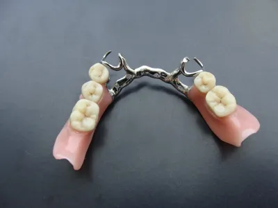 Бюгель - съёмное протезирование зубов