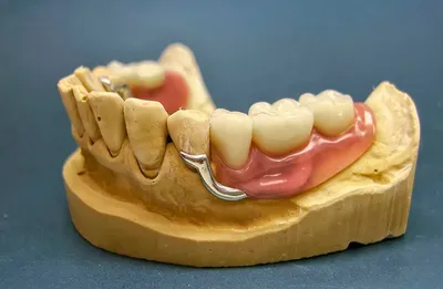 Бюгельные протезы для зубов на верхнюю и нижнюю челюсть