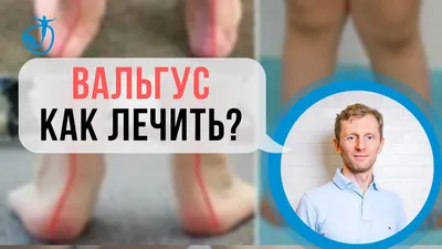Лечение вальгусной деформации стопы в СПб: операции на косточке большого  пальца ноги