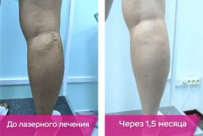 Результаты лечения вариокза | Воронеж | Варикоза Нет