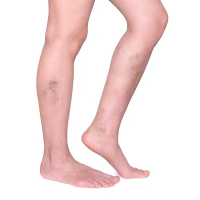 Варикозное расширение вен на ногах женские ноги изолированы на белом |  Премиум Фото