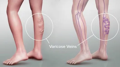 Варикоз на ногах - Многофункциональная медицинская клиника