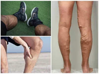 10 причин возникновения варикоза на ногах у мужчин - 10 Причин