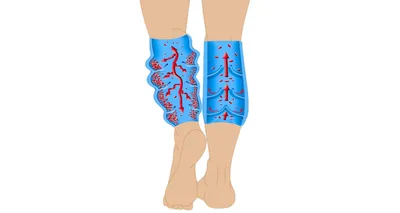 Венозные узлы - как убрать варикозные узлы на ногах? | «Институт Вен»