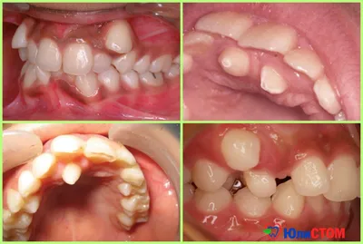 Гипердонтия — когда зубов во рту много