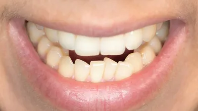 Скученность зубов - причины аномалии прикуса | Лечение зубного ряда к детей  и взрослых