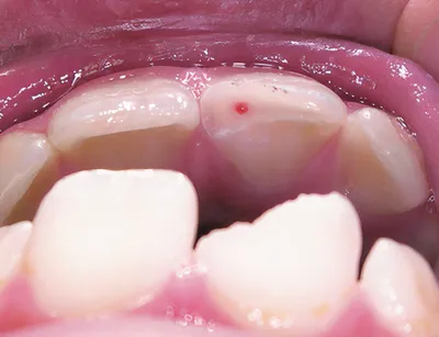 Эндодонтические аспекты лечения зубов после травмы – STOMWEB.RU
