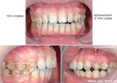 Ортокраниодонт выравнивает зубы и исправляет наклон верхней челюсти для  улучшения эстетики лица