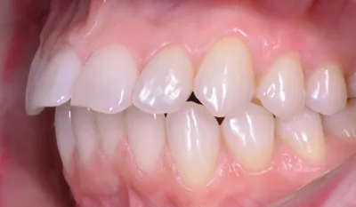 Примеры работ стоматологов - лечение протрузии верхних резцов