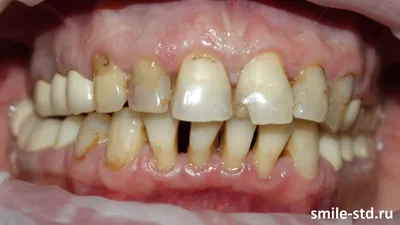 Когда выпадают молочные зубы - Стоматологическая клиника доктора Лапченко -  Блог