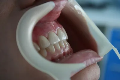 ГАУЗ МО МОСП - 🤒Как выглядят зубы Гетчинсона 🦷В этом случае деформации  подвергаются центральные верхние резцы. Они приобретают бочкообразную форму  с увеличением коронки ближе к пришеечной области. 🦷При этом на режущем крае