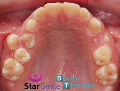 Поддельные зубы Smile Teeth, нижние и верхние поддельные зубы, шпон из  силикагеля, накладные зубы, съемные зубы, стоматологический шпон для ухода  за полостью рта - купить по выгодной цене | AliExpress