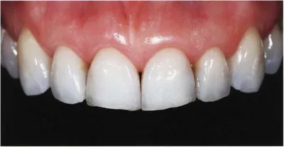 V средняя линия совпадает V верхние зубы перекрывают нижние V зубы стоя