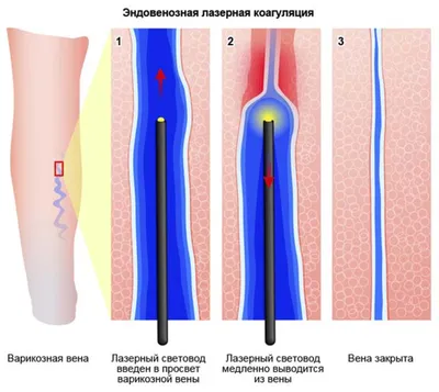 Лазерная коагуляция вен нижних конечностей - Клиника доктора Есиповой