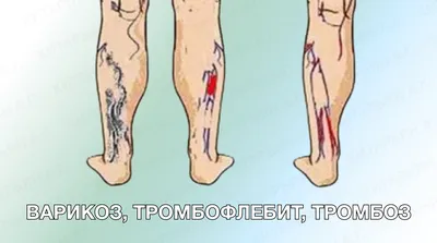 Массаж ног при варикозе ног и нижних конечностей
