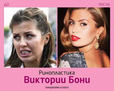 Виктория Боня до и после ринопластики