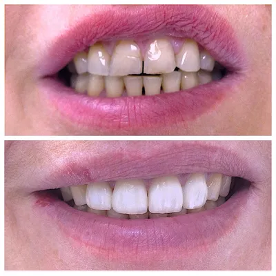 Виниры на зубы - Сеть стоматологических клиник «ОЛЬГА»