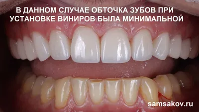 Как обтачивают зубы при установке виниров | Альянс бьюти-ортопедов, Москва