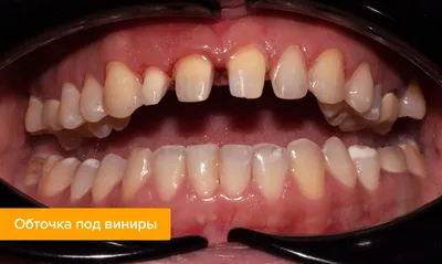 Виниры в стоматологии: сколько держаться, плюсы и минусы установки виниров