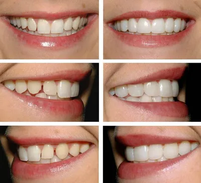 Как устанавливают виниры на зубы | Стоматология Ас-Стом | Санкт-Петербург  (СПб)