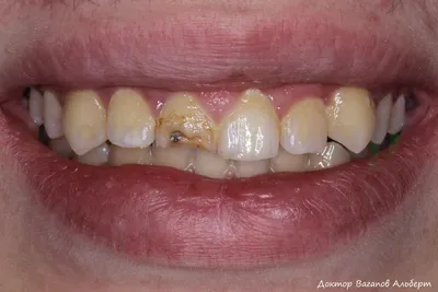 Керамический винир за 1 час на передний зуб с применением CEREC |  Стоматология Dентал Мир