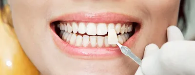 Что такое виниры и как их ставят на зубы? Фото и цены процедуры