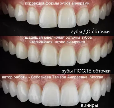 Как можно поставить виниры без обточки эмали зубов | Альянс  бьюти-ортопедов, Москва