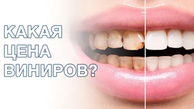 Керамические виниры на передние зубы со скидкой - за 15 000 руб, самая  низкая цена - Недорогая Стоматология в Москве