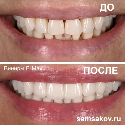 Ставить или не ставить E-max виниры и по какой цене | Альянс  бьюти-ортопедов, Москва