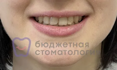 Эстетическая реабилитация фронтальных зубов винирами (случай №68) - фото до  и после | Бюджетная стоматология