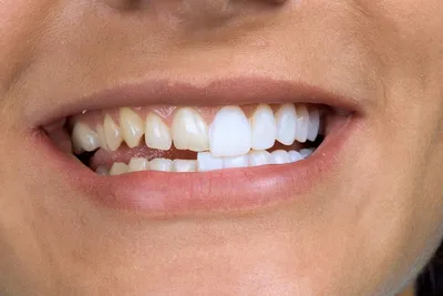 Что такое виниры для зубов, как их устанавливают, столько это стоит —  Ответы врачей стоматологической клиники Миллидент в Казани