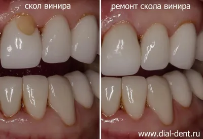 Реставрация скола винира на переднем зубе в день обращения