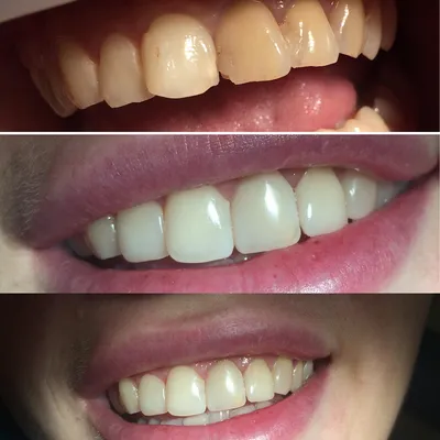 Врачи-стоматологи объяснили, что такое керамические виниры и как за ними  ухаживать