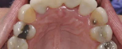 Культевая вкладка под коронку — гарантированный способ сохранить зуб