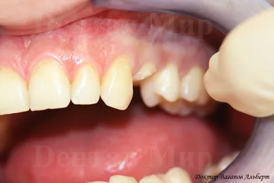 Фотография работы по восстановлению сломанного зуба с помощью безметалловой  коронки