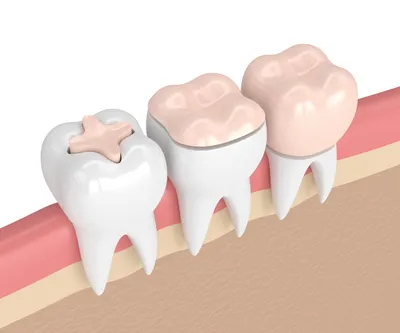 ⚡️ Зубные вкладки по старой цене от 500 руб.⚡️ | Стоматология Ⓜ️ Митино