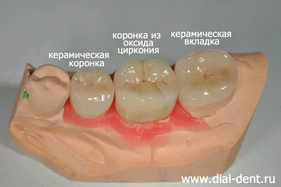Вкладка на зуб фото