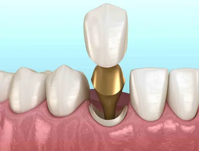 Восстановление зуба вкладкой - Стоматология Приоритет