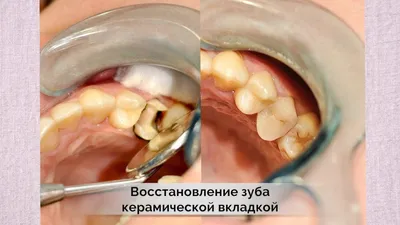 Керамическая вкладка Noritake | протезирование зубов | стоматология Сатори  Самара - YouTube