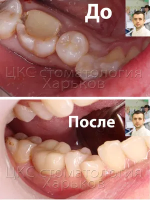 Восстановление разрушенного зуба циркониевой вкладкой и коронкой из  диоксида циркония