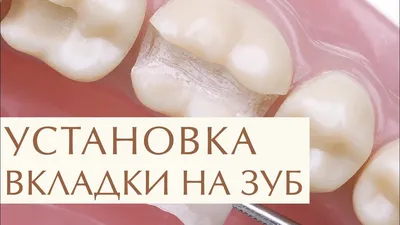 ✨ Плюсы восстановления зуба с помощью керамической вкладки. Керамическая  вкладка на зуб. 12+ - YouTube
