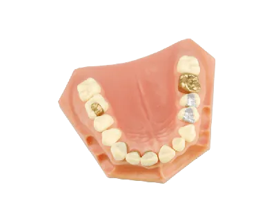 Установка зубной вкладки в СПб: цена от 4 500 ₽ на зуб в стоматологии  OrthoLove